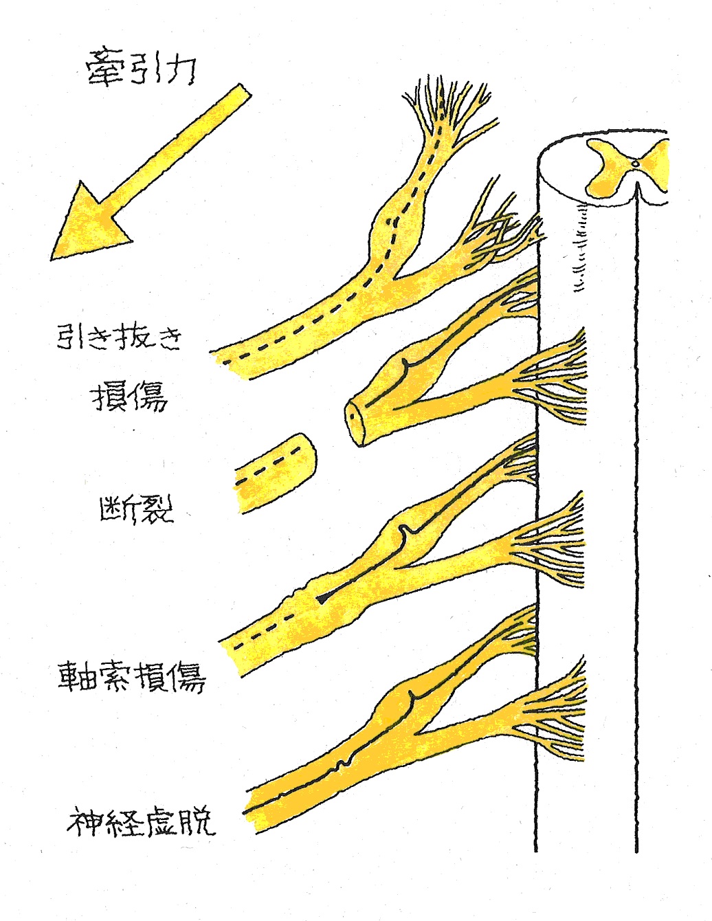 17 バーナー症候群 交通事故後遺症の法律相談は被害者側専門弁護士｜東京渋谷法律事務所