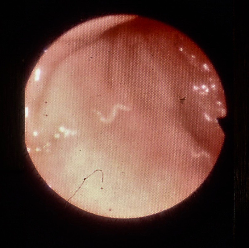 threadworm1 A Paediatrician's Life