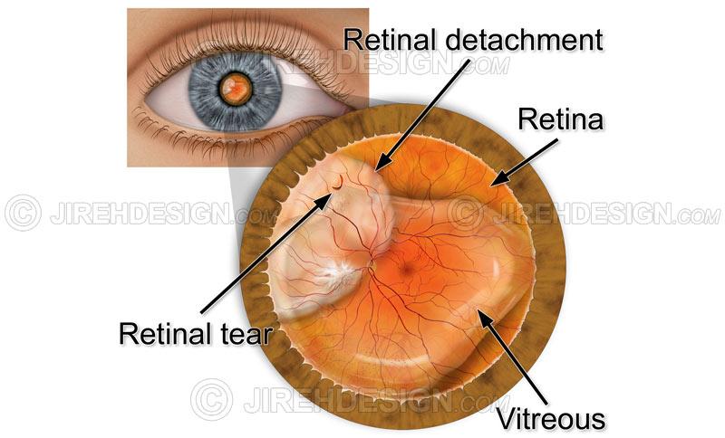 Eye And Retina Surgeons Camden : Retinal detachment with tear - #CO0084 | Stock eye images