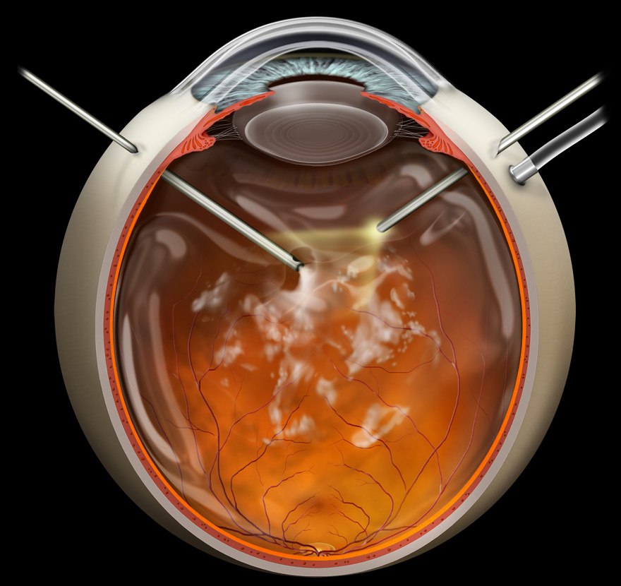 Pars plana vitrectomy interactive Stock eye images