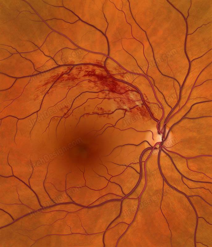 Branch retinal vein occlusion with arteriovenous nicking