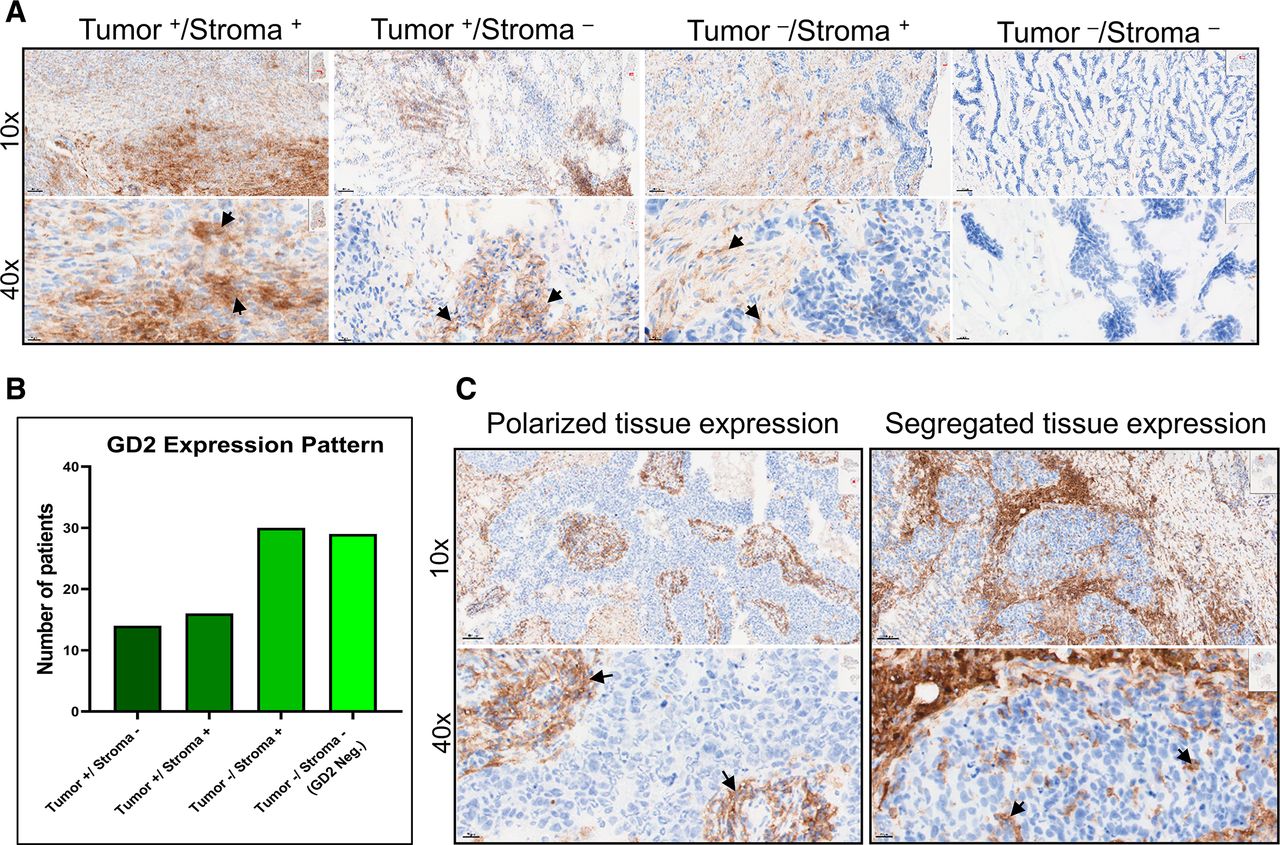 AntiGD2 antibody dinutuximab inhibits triplenegative breast tumor