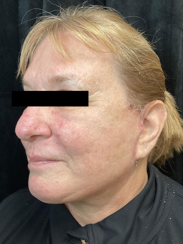 Best Mini Facelift Surgeon Raleigh, NC Dr. Sumeet Jindal