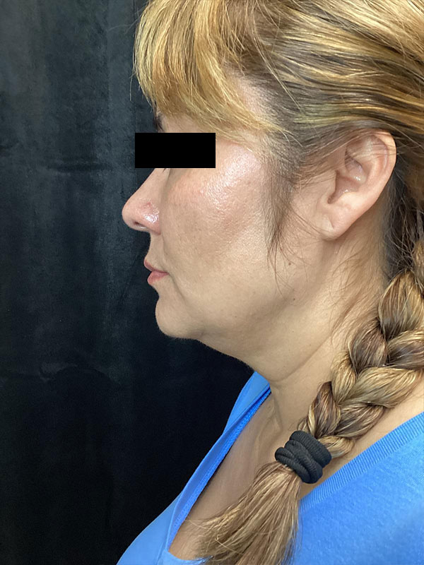 Best Mini Facelift Surgeon Raleigh, NC Dr. Sumeet Jindal