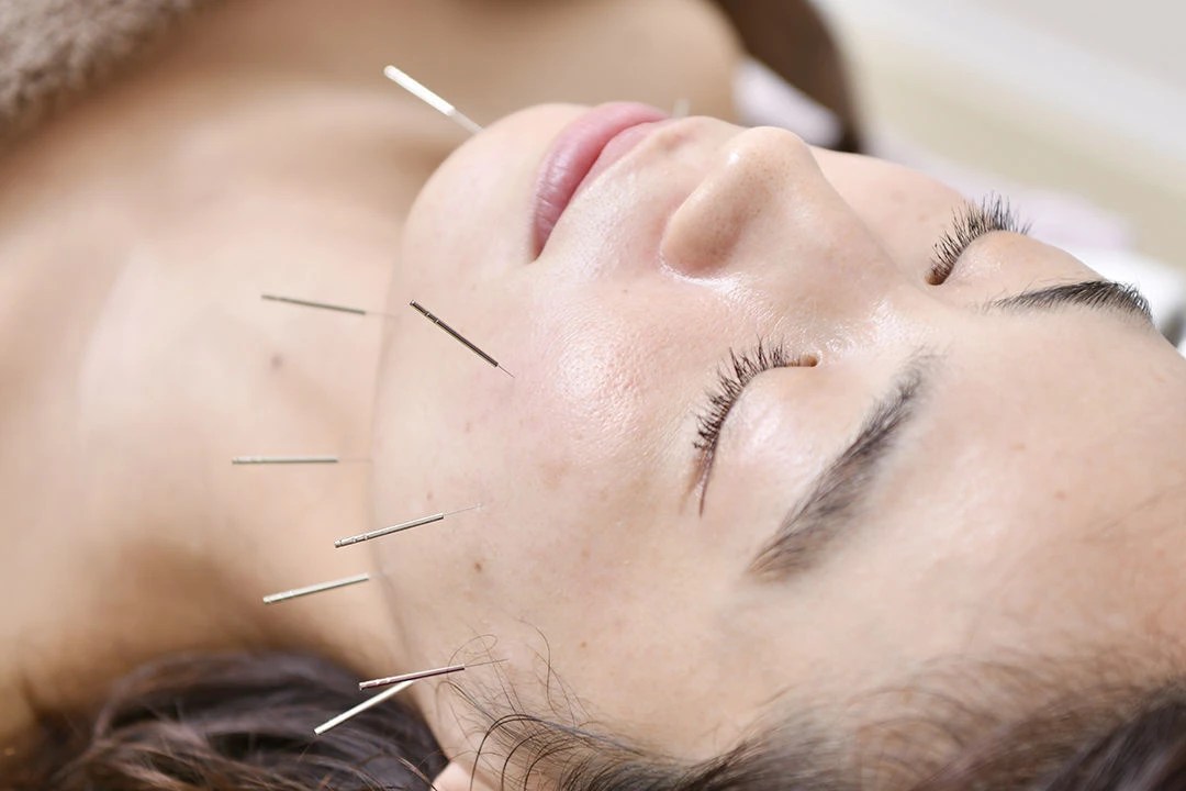 美容鍼（はり） 自由が丘整骨院は整体や事故治療等様々な施術に対応できる技術がございます