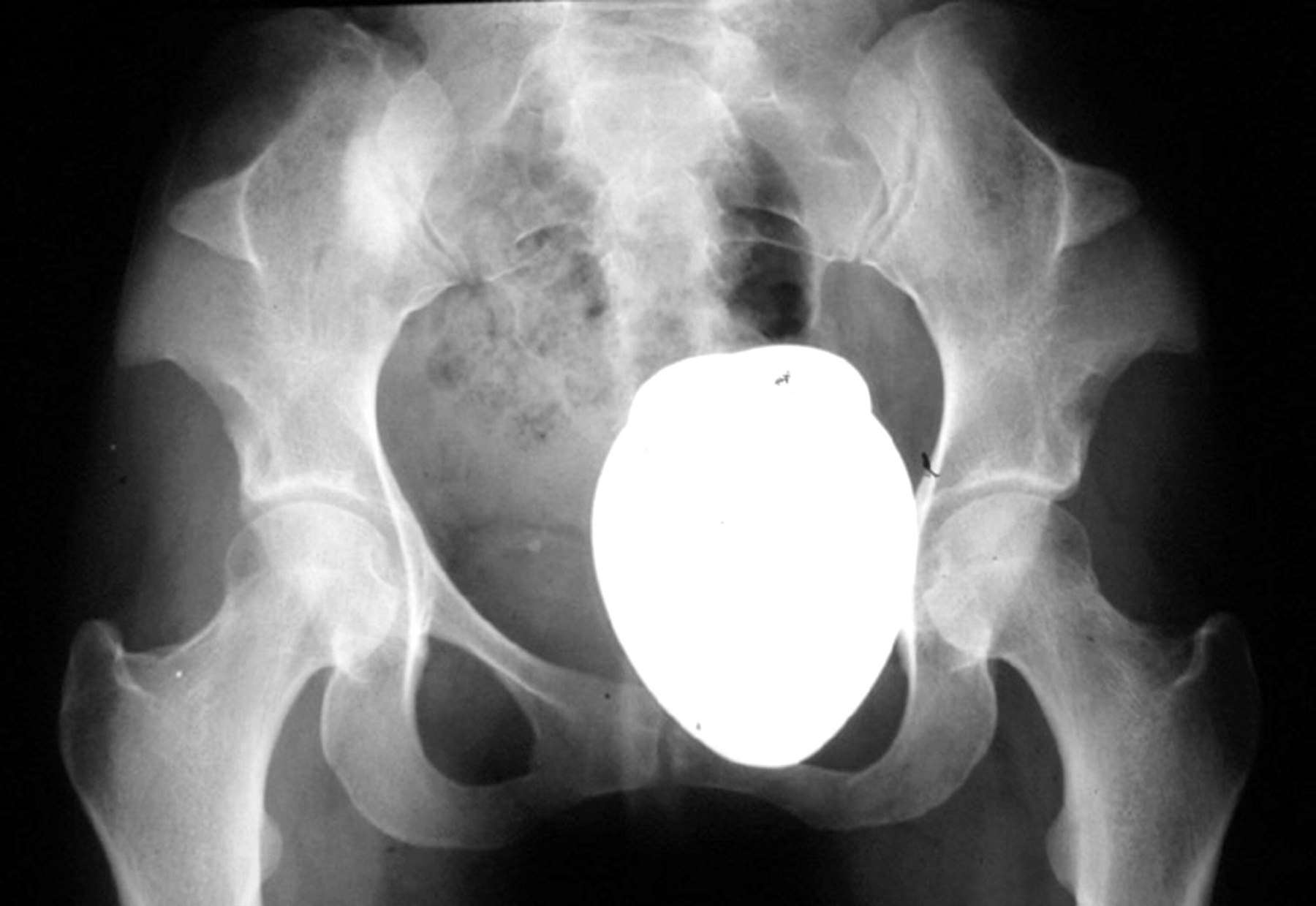 nailpatella syndrome meddic