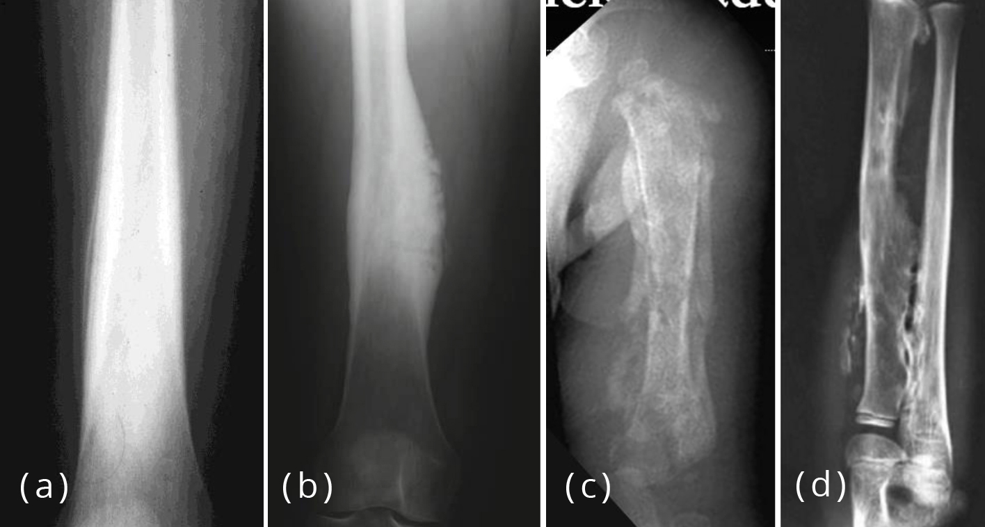 Periosteal Reaction Causes