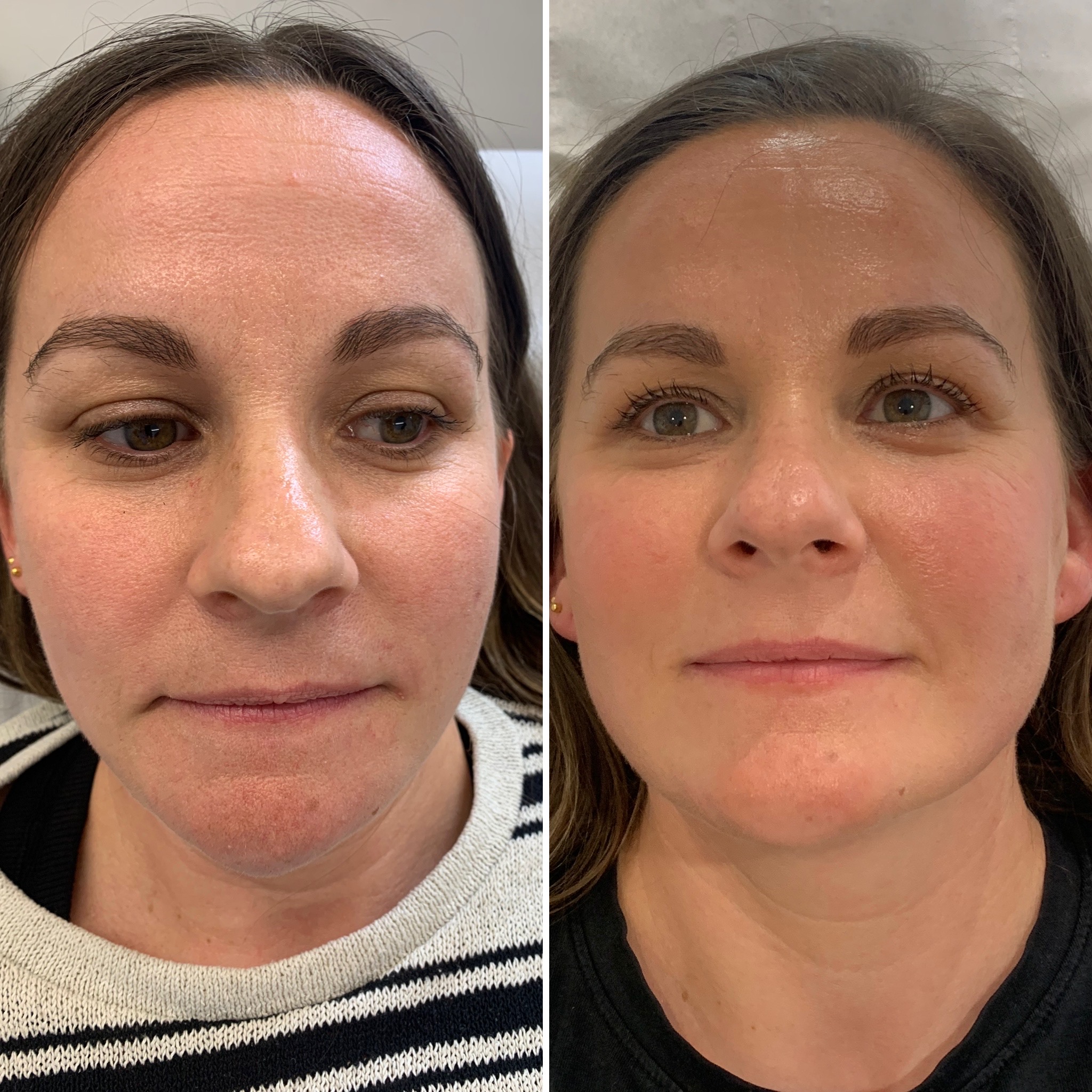 Advanced Skincare Ashford Profhilo Skin Booster Injections