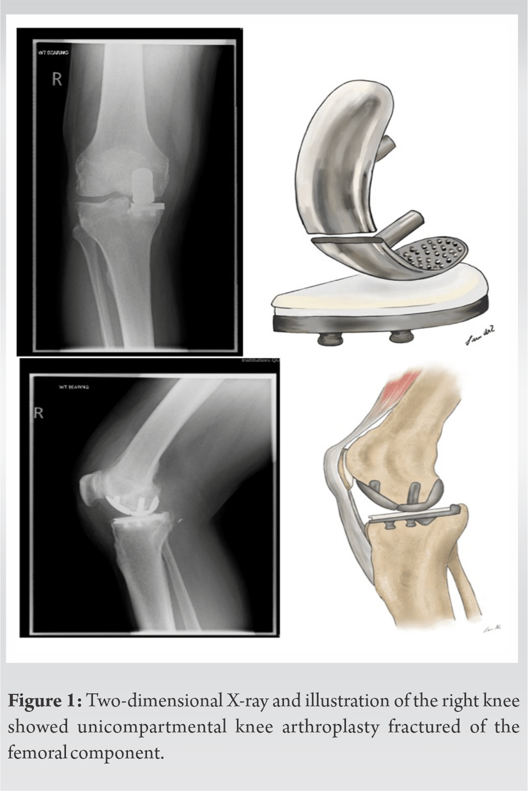 A Case Report of Knee Arthroplasty Fracture of the