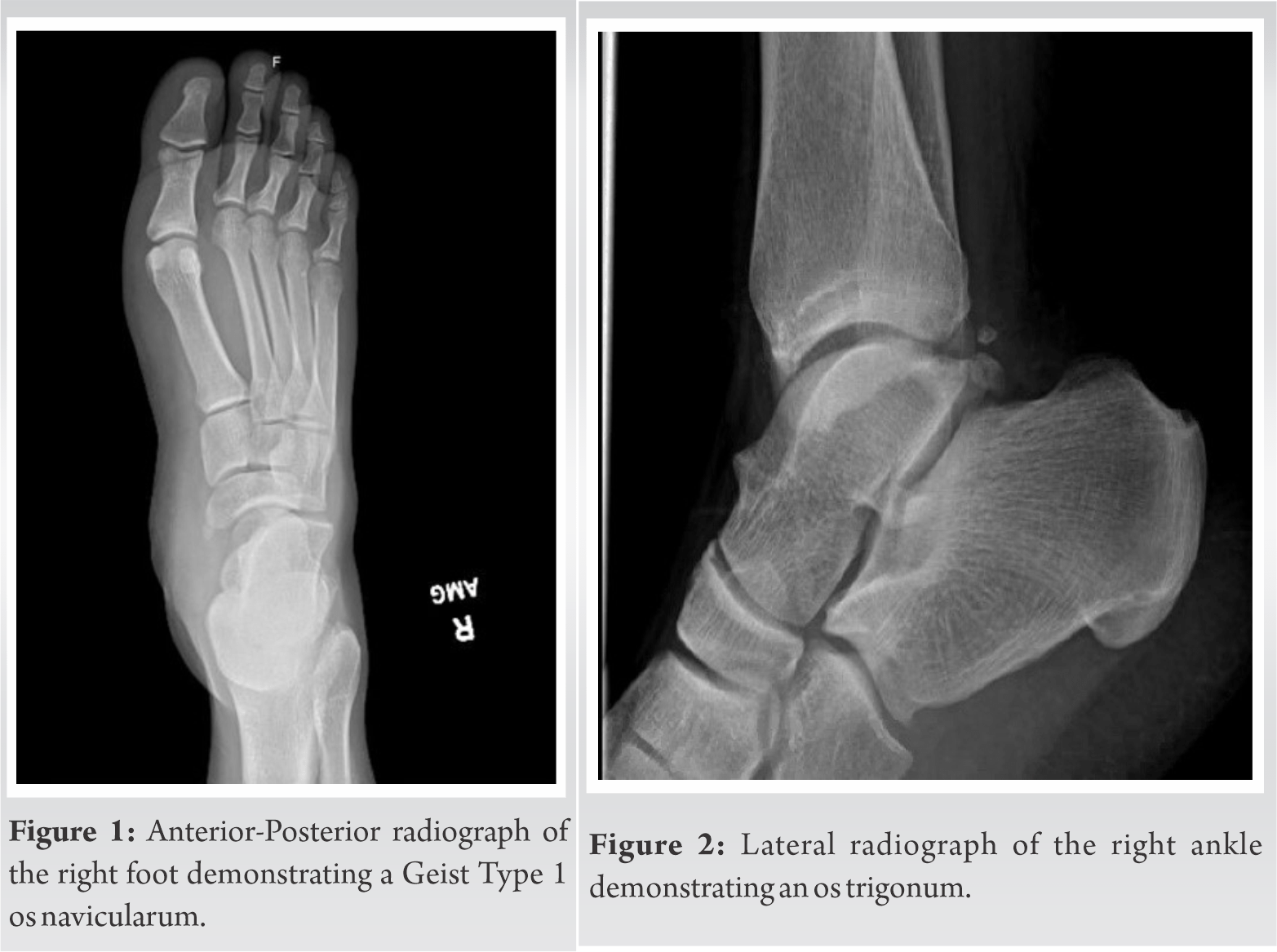 Atraumatic Exertional Compartment Syndrome of the Medial Foot Case
