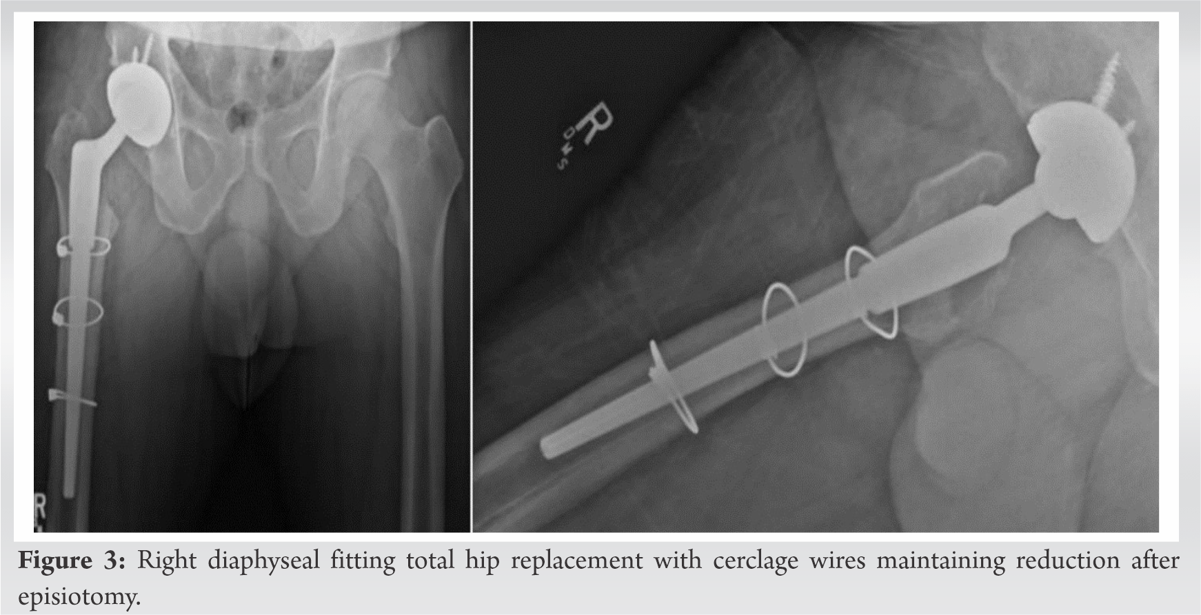 Episiotomyassisted Incarcerated Femoral Nail Removal Technical Note