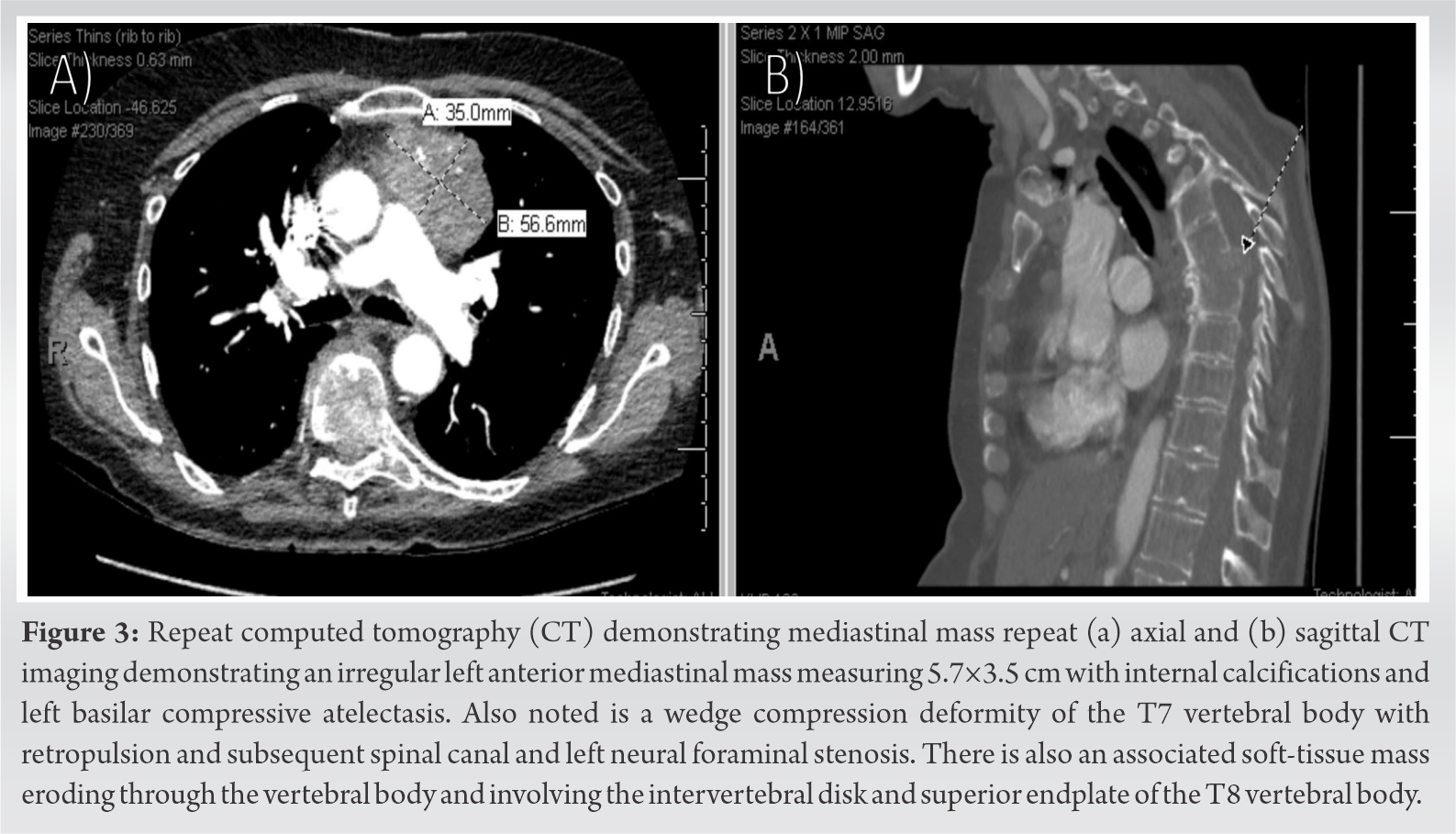 Type A Thymoma with Spinal and Cranial Metastases A Case Report