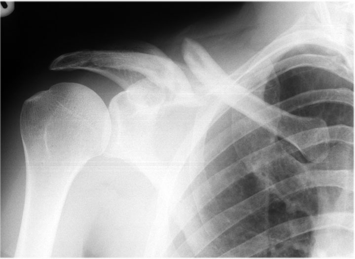 John's Clavicle Page