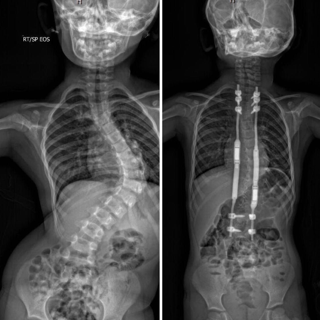 Magec Rods South Florida Spinal Surgeon Scoliosis, Complex Deformity