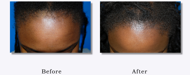 Black Men & Women Hair Transplant Photos Columbus, OH Hair Loss