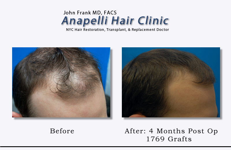 Before & After (4 Months Postop) 1769 Grafts Anapelli Hair Clinic