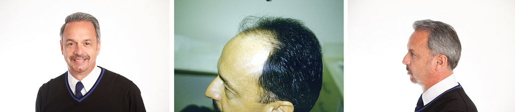 Before & After Hair Transplant Gallery Columbus, OH Hair Loss