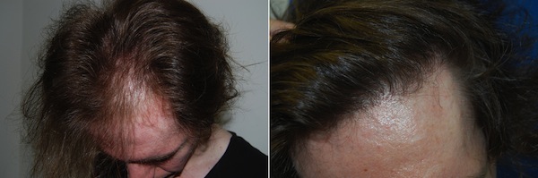 Before & After Hair Transplant Gallery Columbus, OH Hair Loss