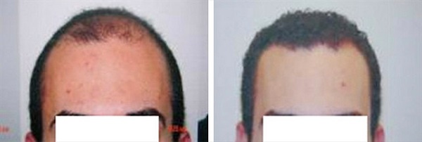 Before & After Hair Transplant Gallery Columbus, OH Hair Loss