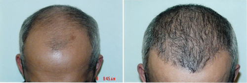 Before & After Hair Transplant Gallery Columbus, OH Hair Loss
