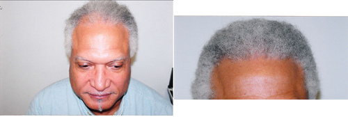 Before & After Hair Transplant Gallery Columbus, OH Hair Loss