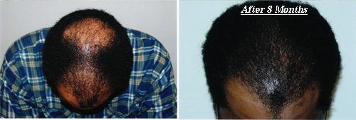 Before & After Hair Transplant Gallery Columbus, OH Hair Loss
