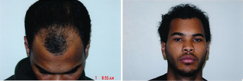 Before & After Hair Transplant Gallery Columbus, OH Hair Loss