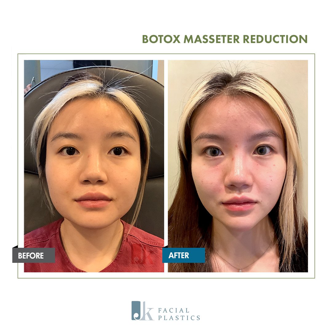 Facial Slimming 2022 and Beyond! Part I John Kang MD F.A.C.S JK