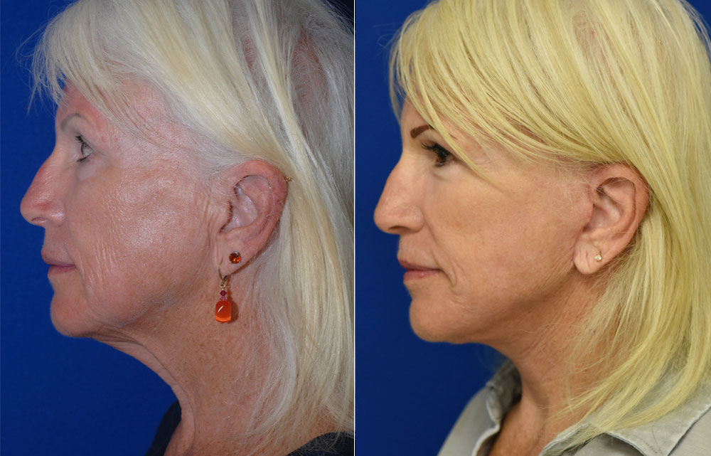 Facelift Patient 1 Photos John Park MD Plastic Surgery, Newport Beach, CA
