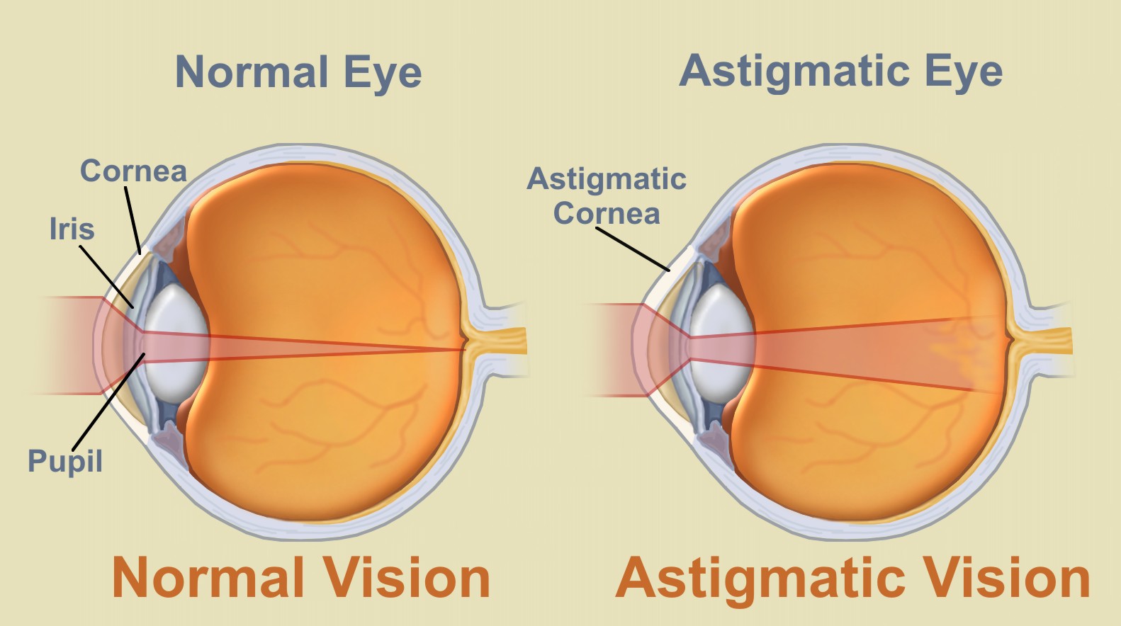 Refractive Eye Conditions Johnson Optometric