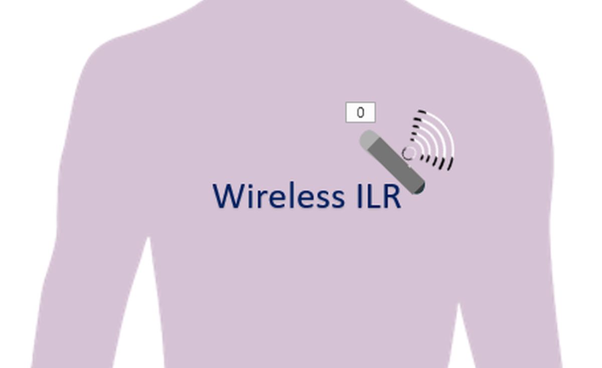 What is an implantable loop recorder? All About Heart And Blood Vessels
