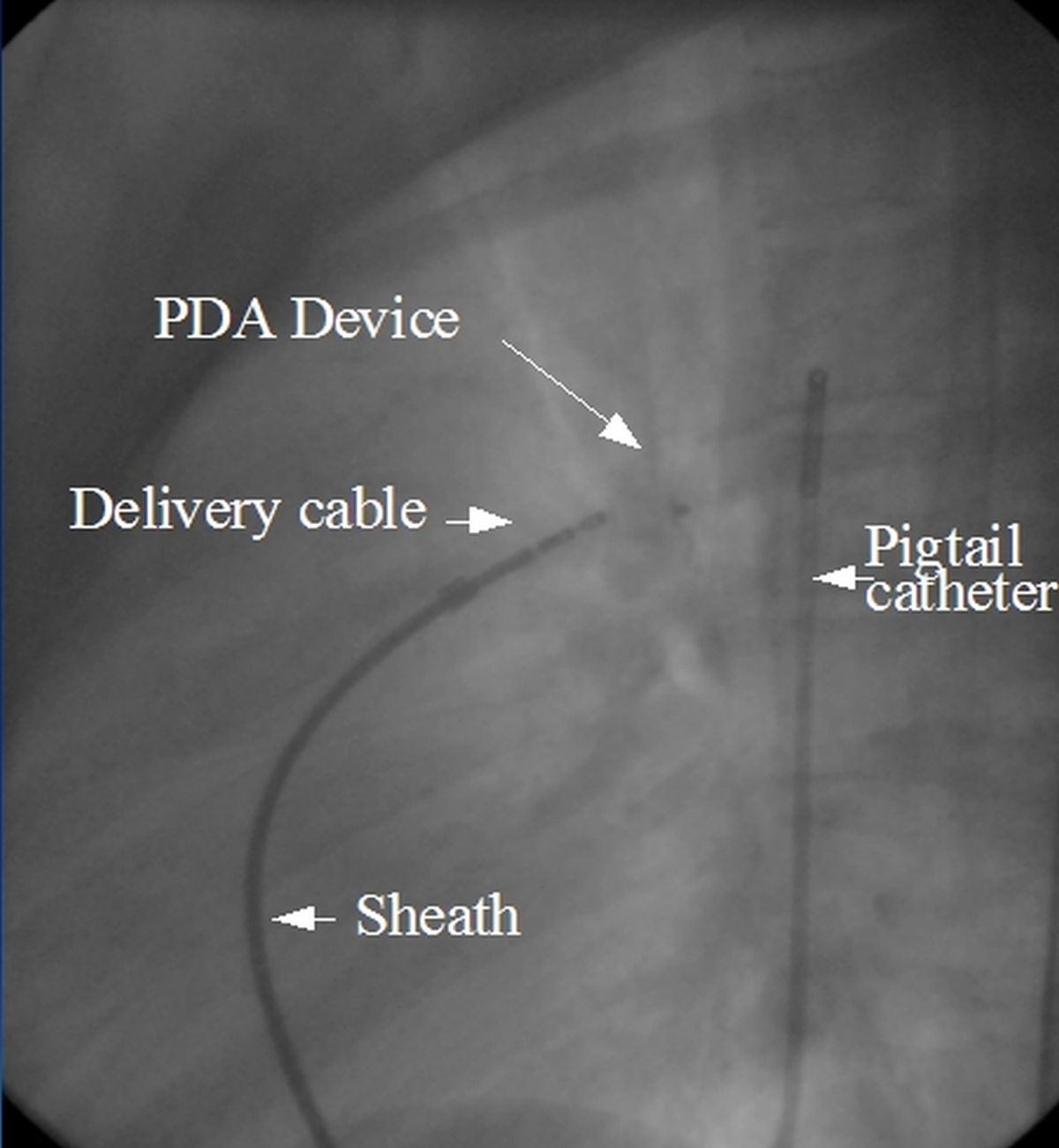 Device closure of PDA All About Heart And Blood Vessels