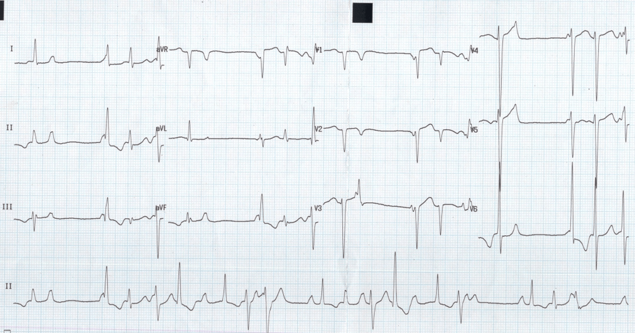 Complex Ventricular Ectopy All About Cardiovascular System and Disorders