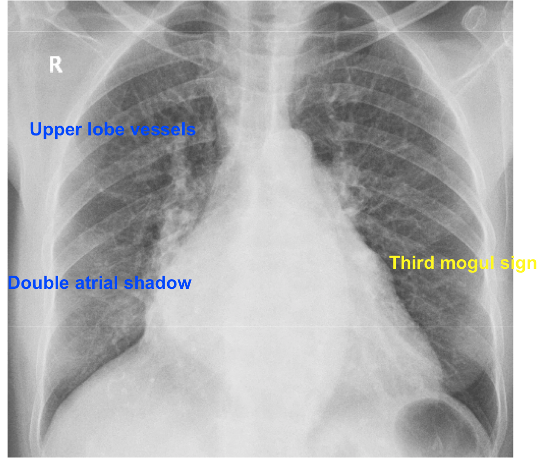 Double atrial shadow and prominent upper lobe vessels All About