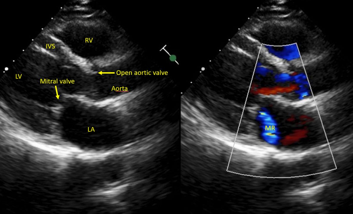 Rheumatic heart disease, mitral regurgitation