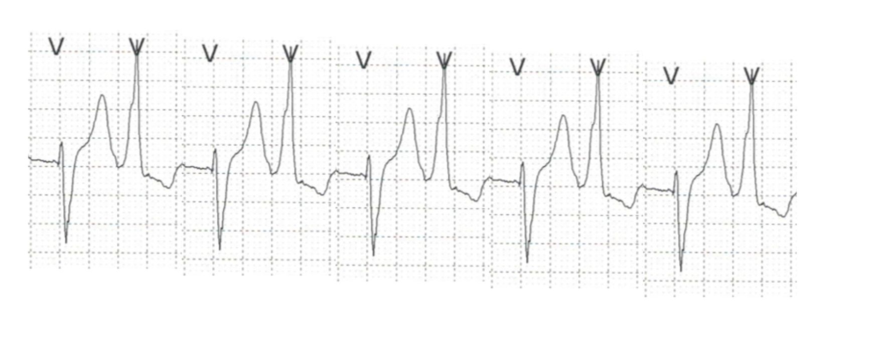 Diagnosis of ventricular tachycardia All About Cardiovascular System