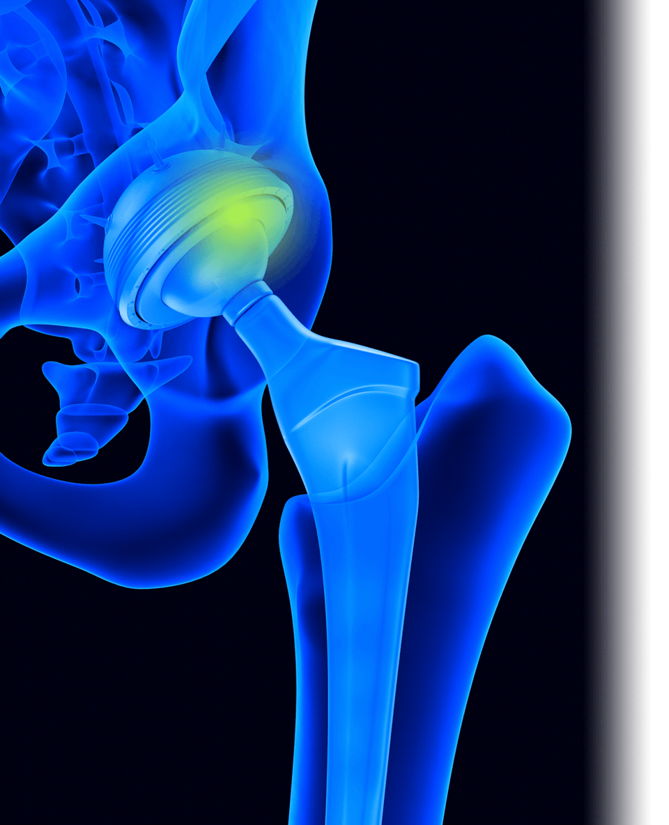 Scottsdale Hip Replacement Doctor Hip Surgery Specialists