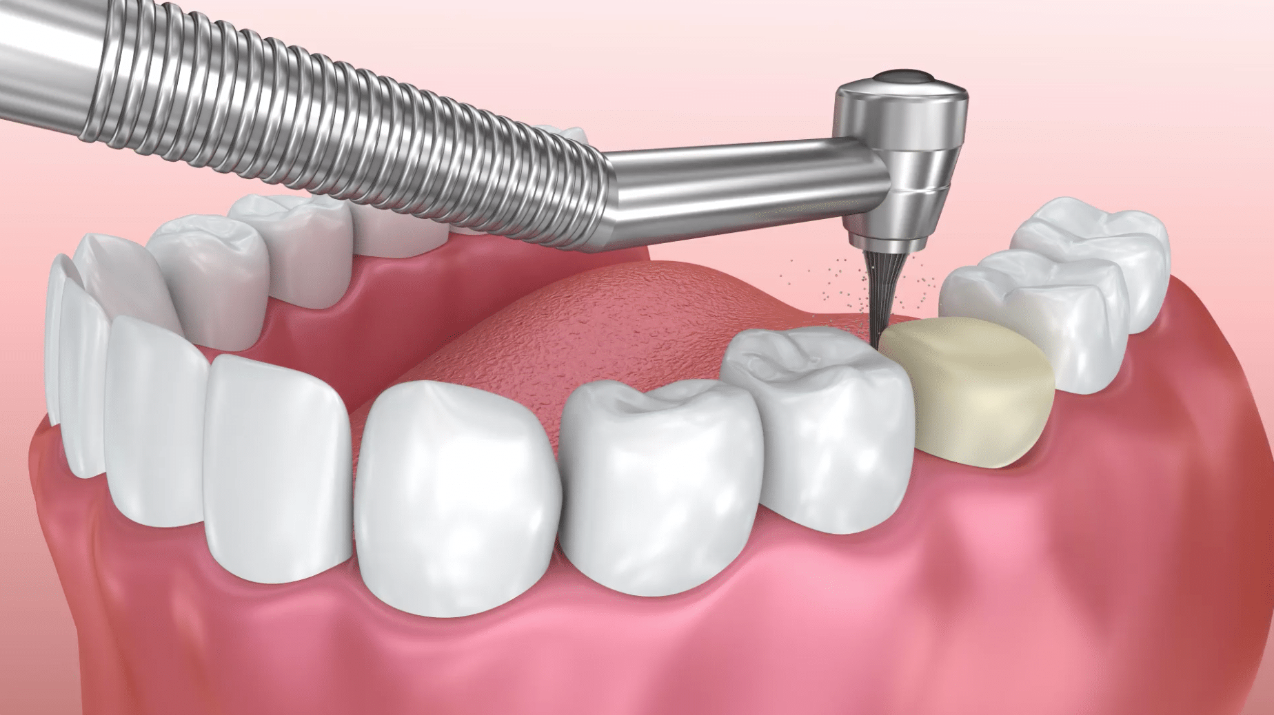 Dental Crown Cost And Who Needs Them? Joom LTI