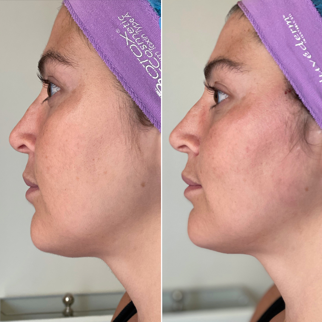 Thread Lifting in NYC NonSurgical Facelift in Manhattan, Nyack