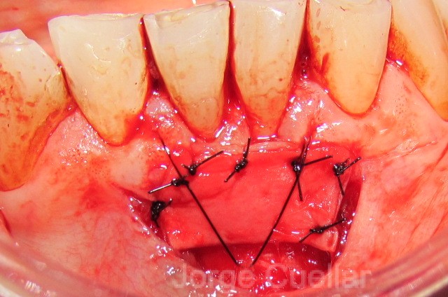 Gingival Graft Cuellar