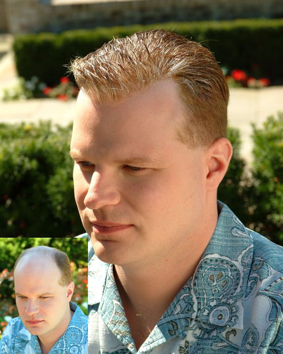 Medical Hair Prosthetic Chemo Hair Replacement