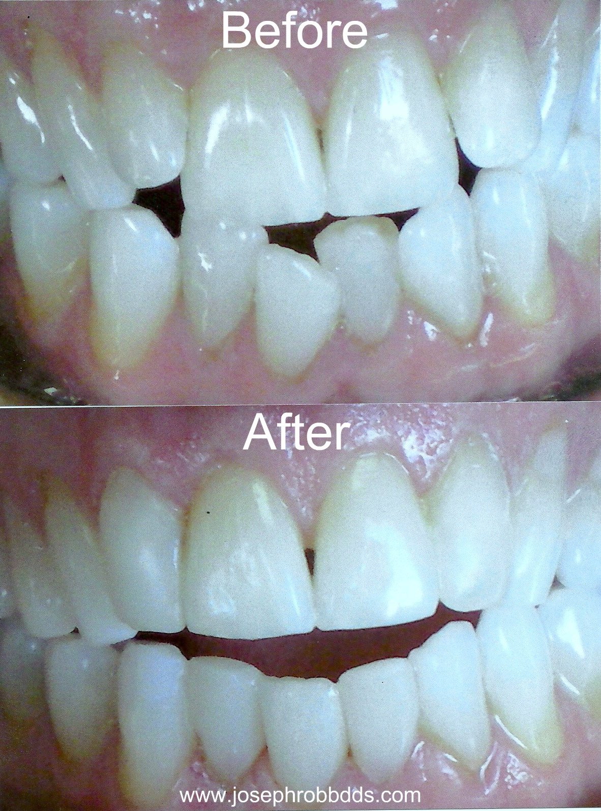 Joseph W. Robb Instant Braces