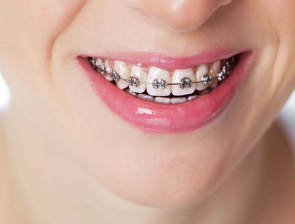 Tipos de Braces Dr. Jose Vicens