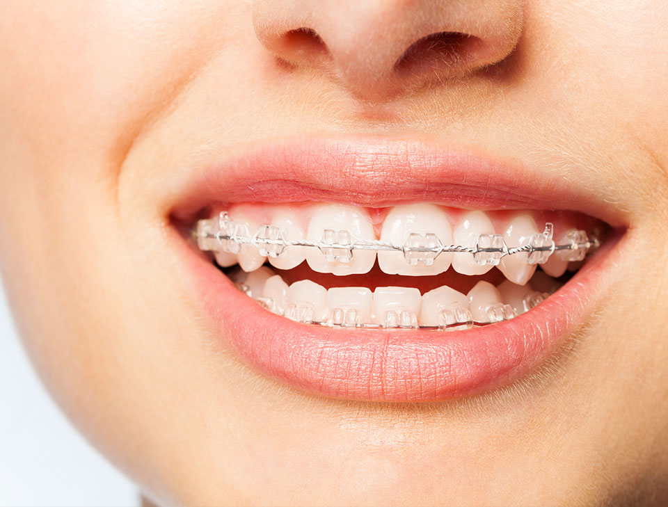 Tipos de Braces Dr. Jose Vicens