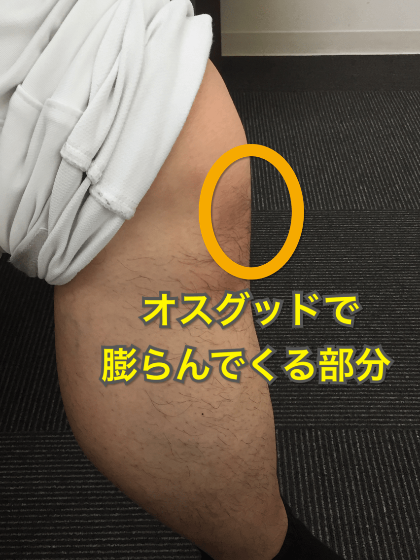 オスグッドを治すための食事の摂り方 大阪市城東区 鴫野で整体 筋膜リリース アキュスコープ治療なら城東整骨院