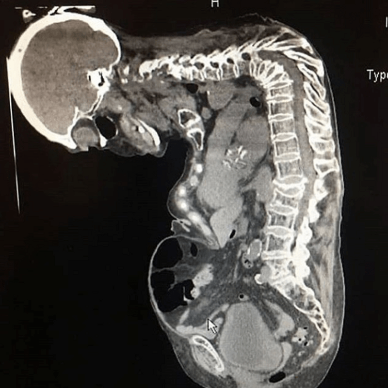 An Extreme Case Of Gibbus Deformity MEDizzy Journal