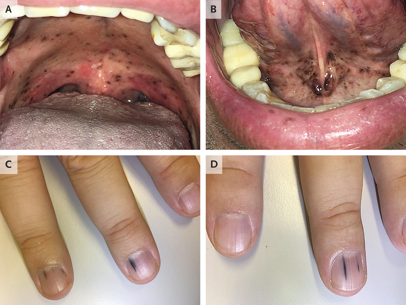Numerous Pigmented Lesions On Oral Mucosa And Nail Beds MEDizzy Journal