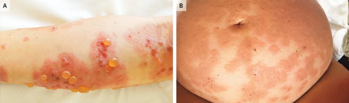 Pruritic Vesicular Rash In A Pregnant Woman… Spot diagnosis? MEDizzy