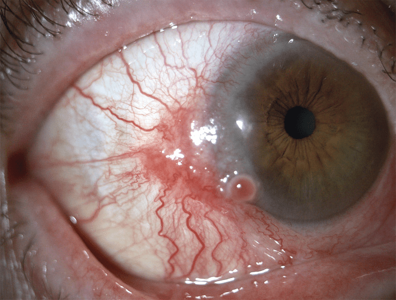 Conjunctival Cancer MEDizzy Journal