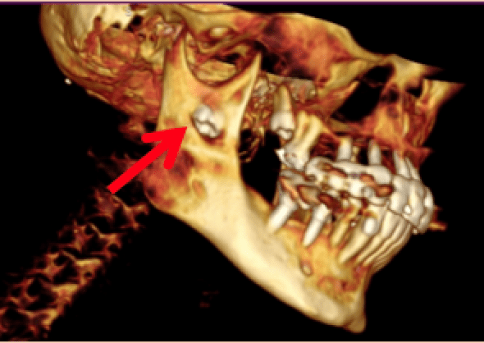 Infected Ectopic Wisdom Tooth MEDizzy Journal